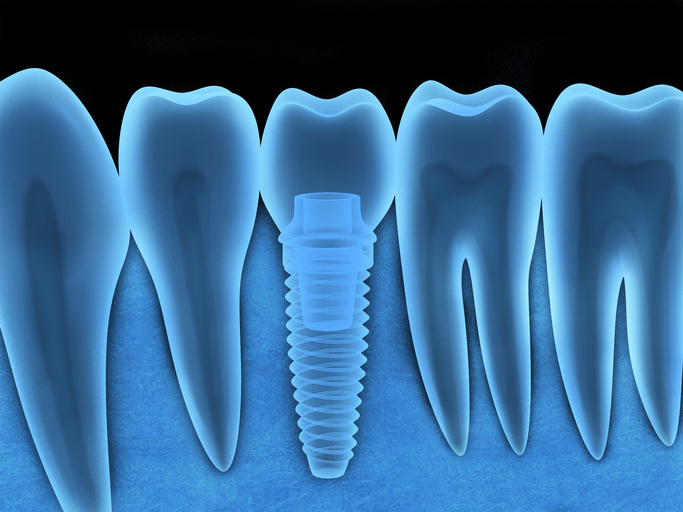 dental implant blue diagram